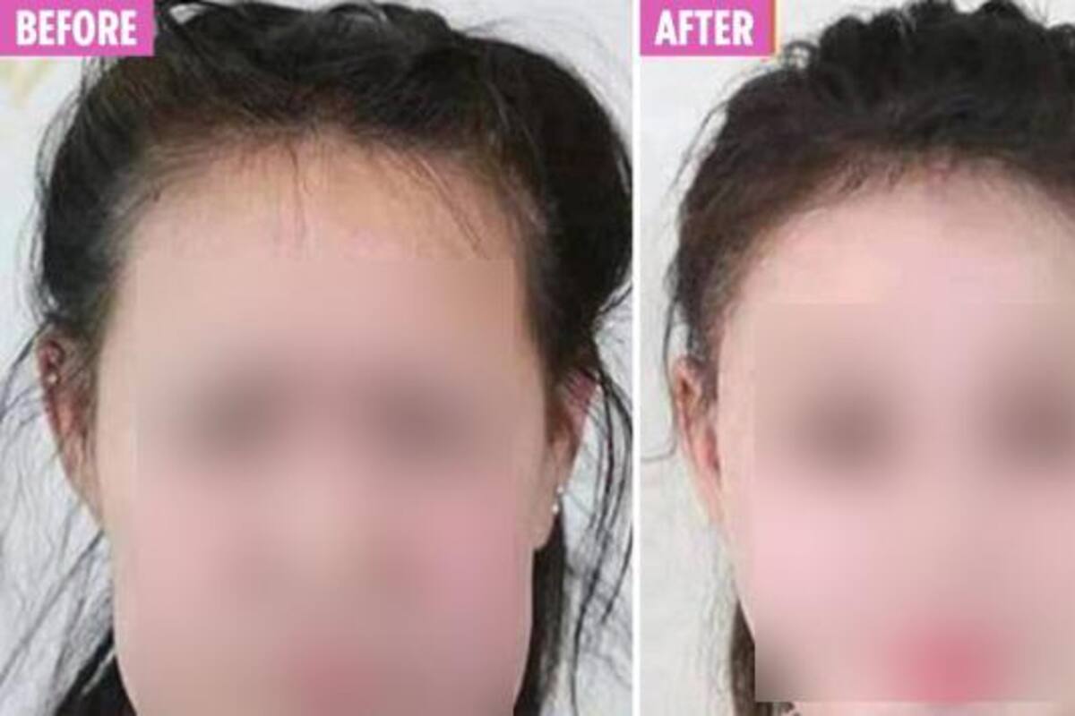 Niña de 15 años, con rara condición que la hizo parecer anciana, tiene una "nueva cara"
