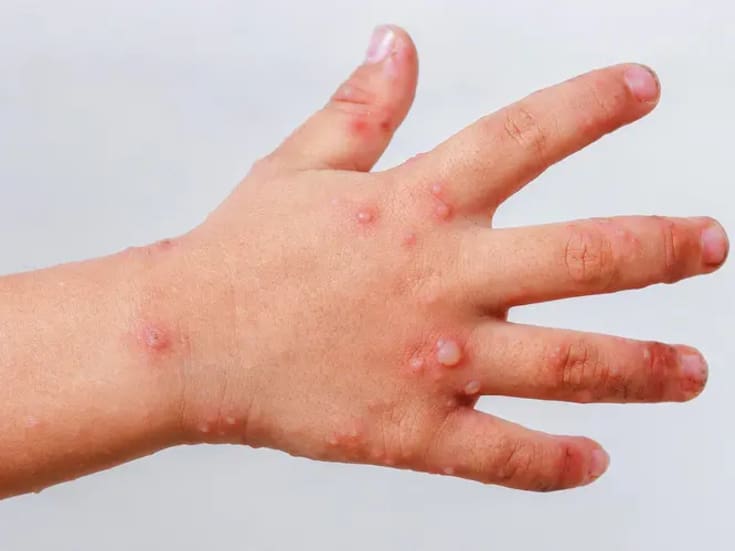 San Felipe y Rosarito sin casos del virus Coxsackie