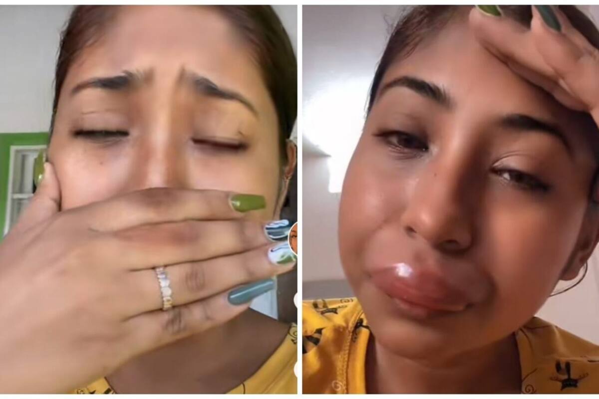 Comparte cómo se hinchó tras el piquete de una abeja en la cara