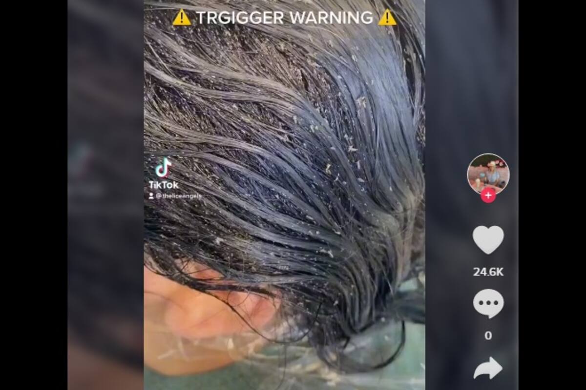 Viral: Cabeza de niña infestada con piojos aterroriza TikTok