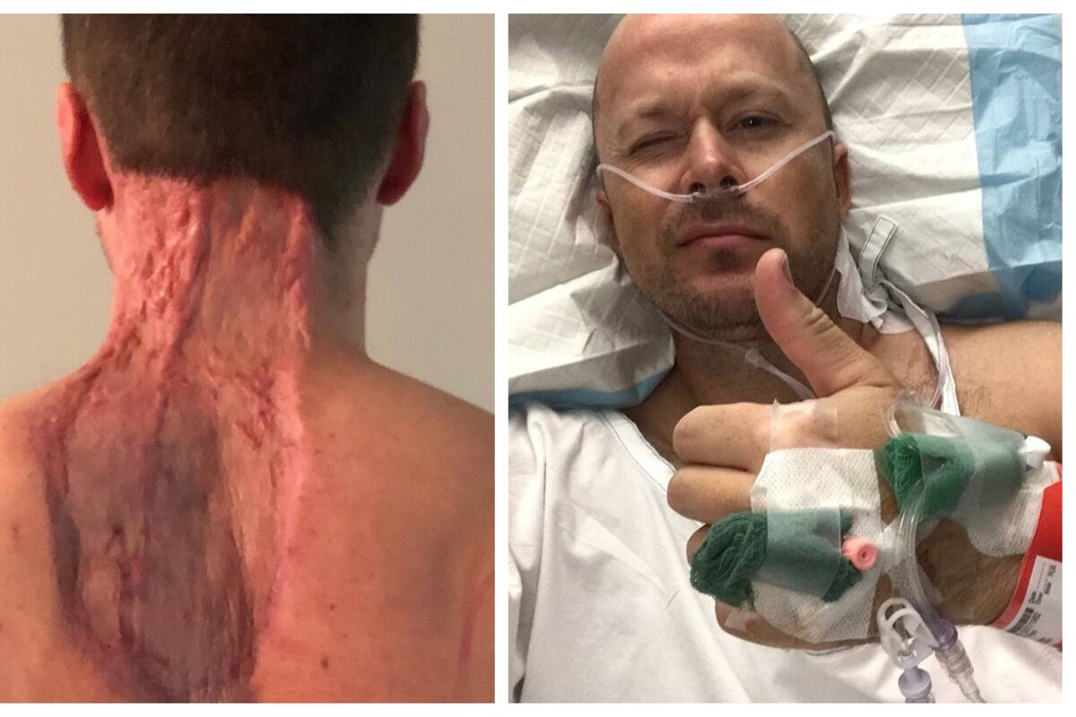 El peligro del Sol: Arrancan enorme pedazo de piel a hombre para quitar melanoma mortal
