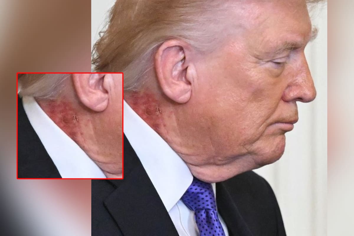 ¿Qué le pasa a Trump en el cuello? Captan erupción que se ha vuelto viral
