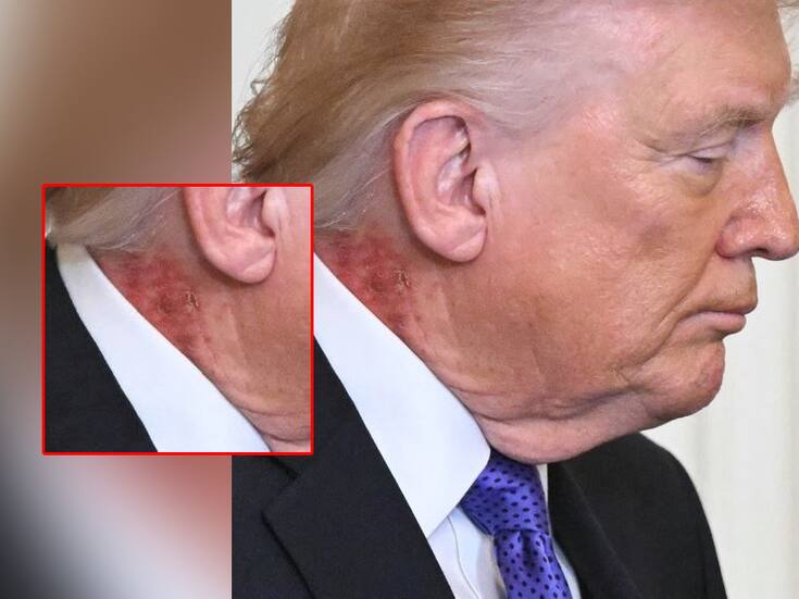 ¿Qué le pasa a Trump en el cuello? Captan erupción que se ha vuelto viral