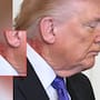 ¿Qué le pasa a Trump en el cuello? Captan erupción que se ha vuelto viral