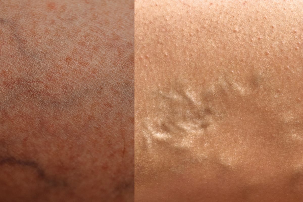 La diferencia entre las venas varicosas y las arañas vasculares: y cómo puedes prevenirlas realmente