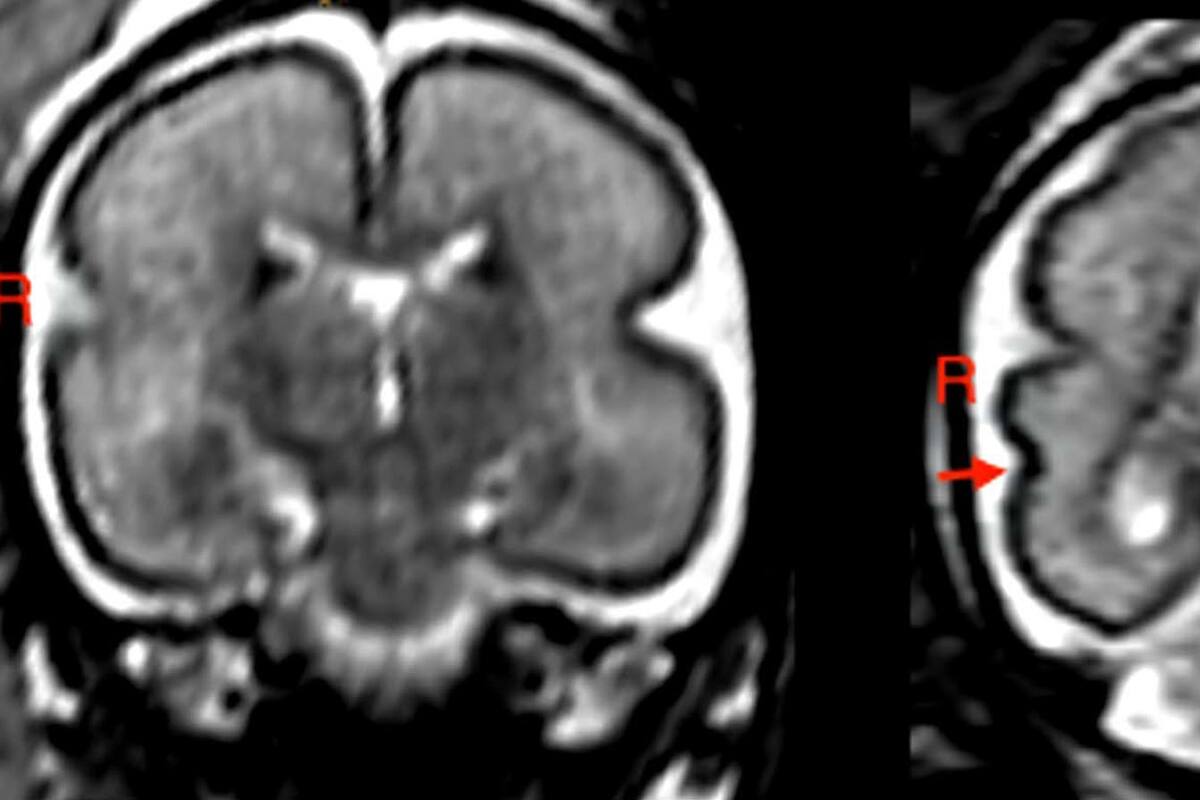 Beber en el embarazo, incluso poco, genera cambios en el cerebro del bebé