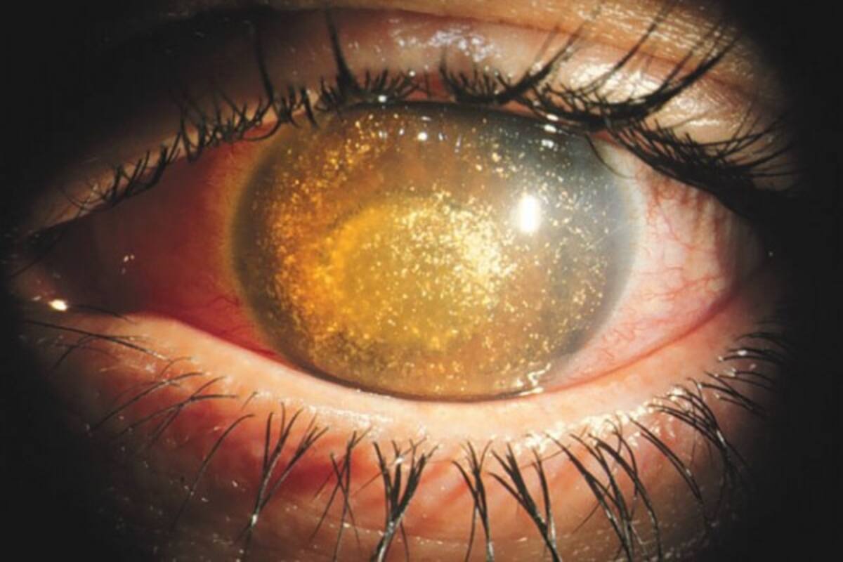 La enfermedad de Benson: este padecimiento les da ‘ojos de galaxia’ a quienes la sufren