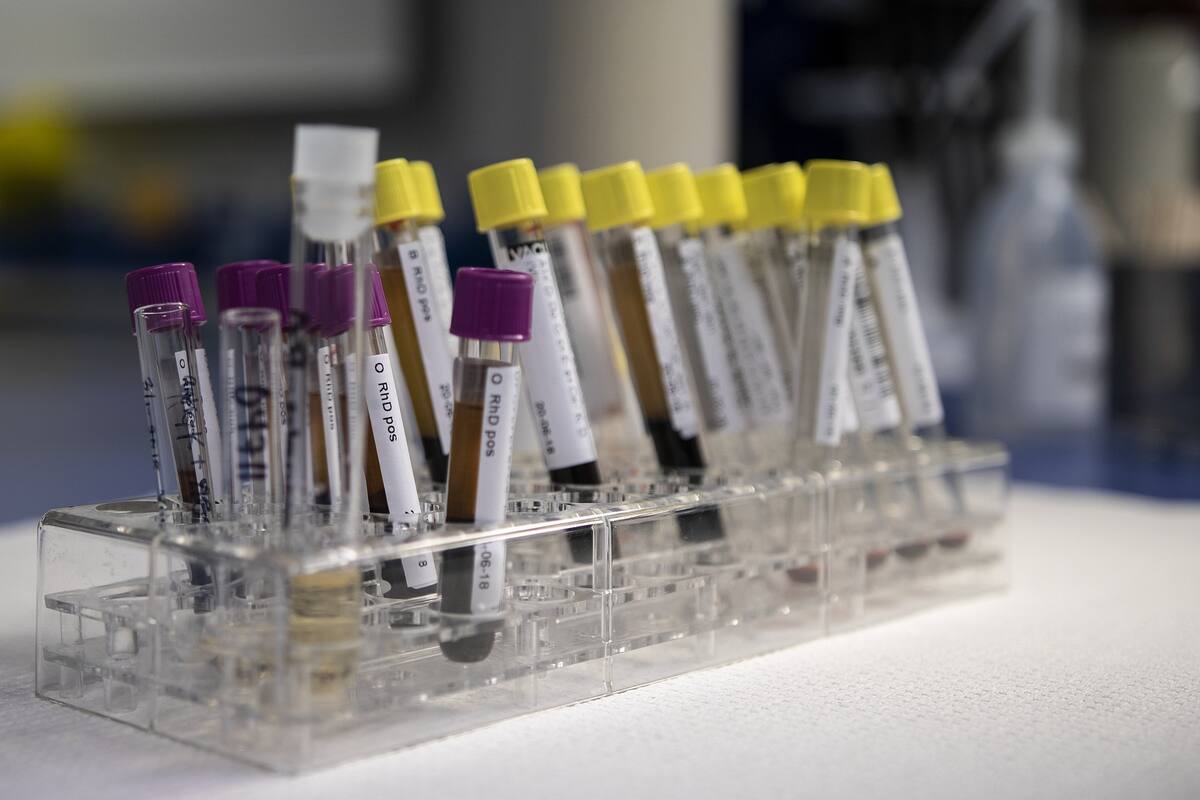 Japón autoriza comercialización de prueba sanguínea para detectar el Alzheimer