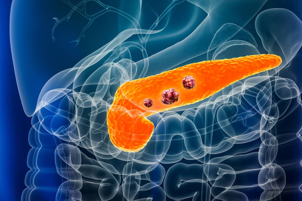 Científicos en España logran eliminar tumores de páncreas en animales y evitar recaídas: qué descubrieron y por qué importa