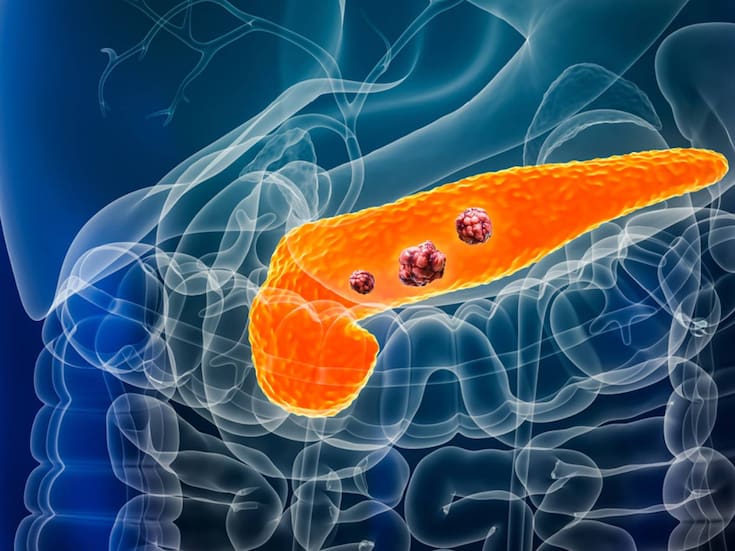 Científicos en España logran eliminar tumores de páncreas en animales y evitar recaídas: qué descubrieron y por qué importa