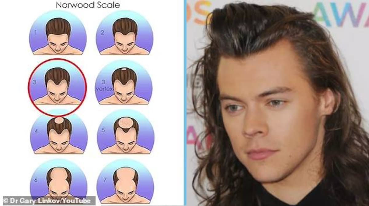 Para los 25 años, Styles ya presentaba evidencia de pérdida de cabello