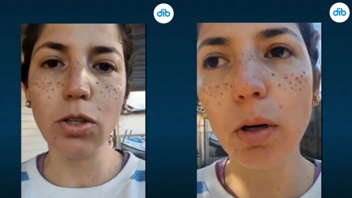 Le quedaron marcas y lesiones: mujer argentina causa polémica tras sufrir una mala pigmentación de pecas