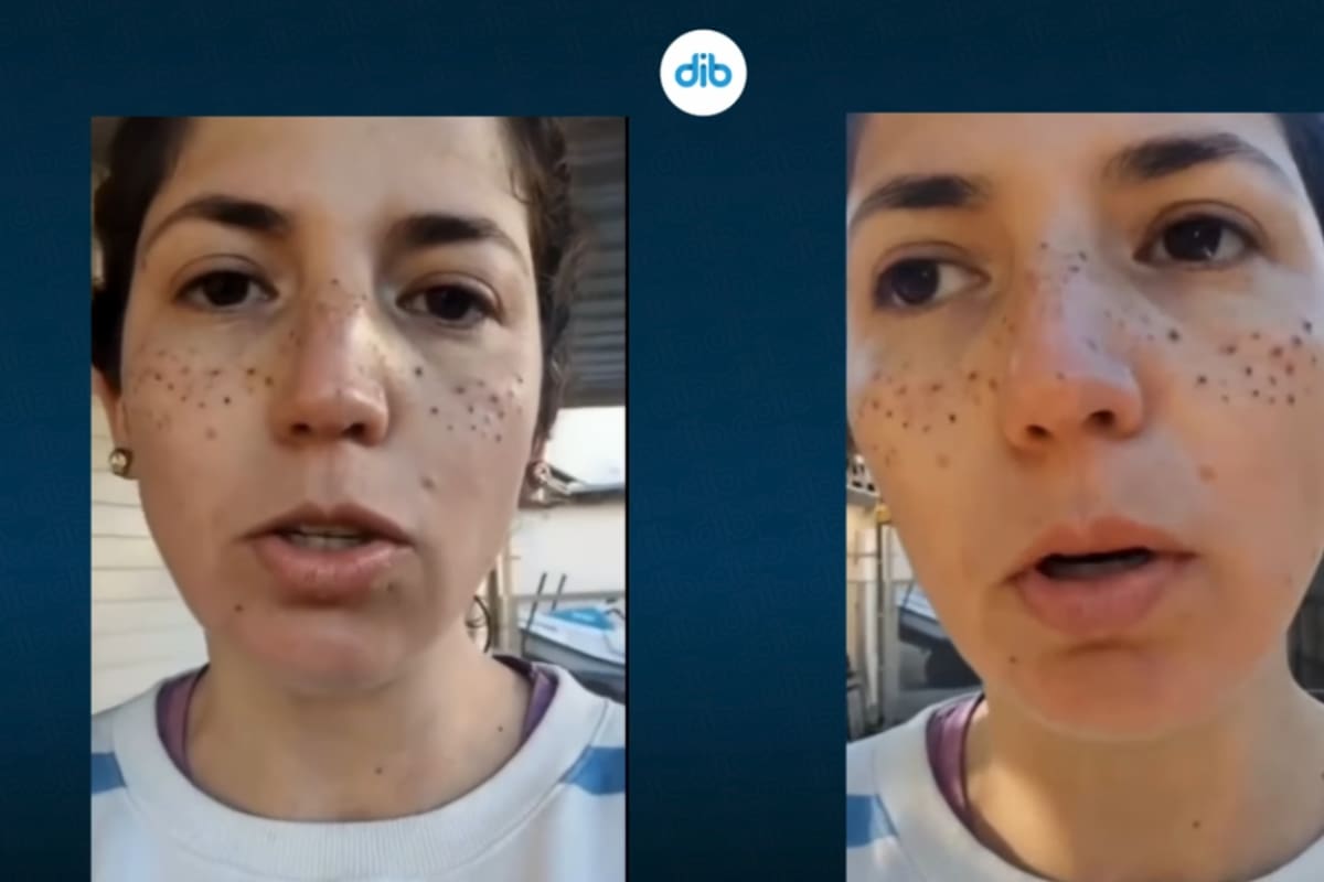 Le quedaron marcas y lesiones: mujer argentina causa polémica tras sufrir una mala pigmentación de pecas
