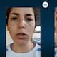 Le quedaron marcas y lesiones: mujer argentina causa polémica tras sufrir una mala pigmentación de pecas