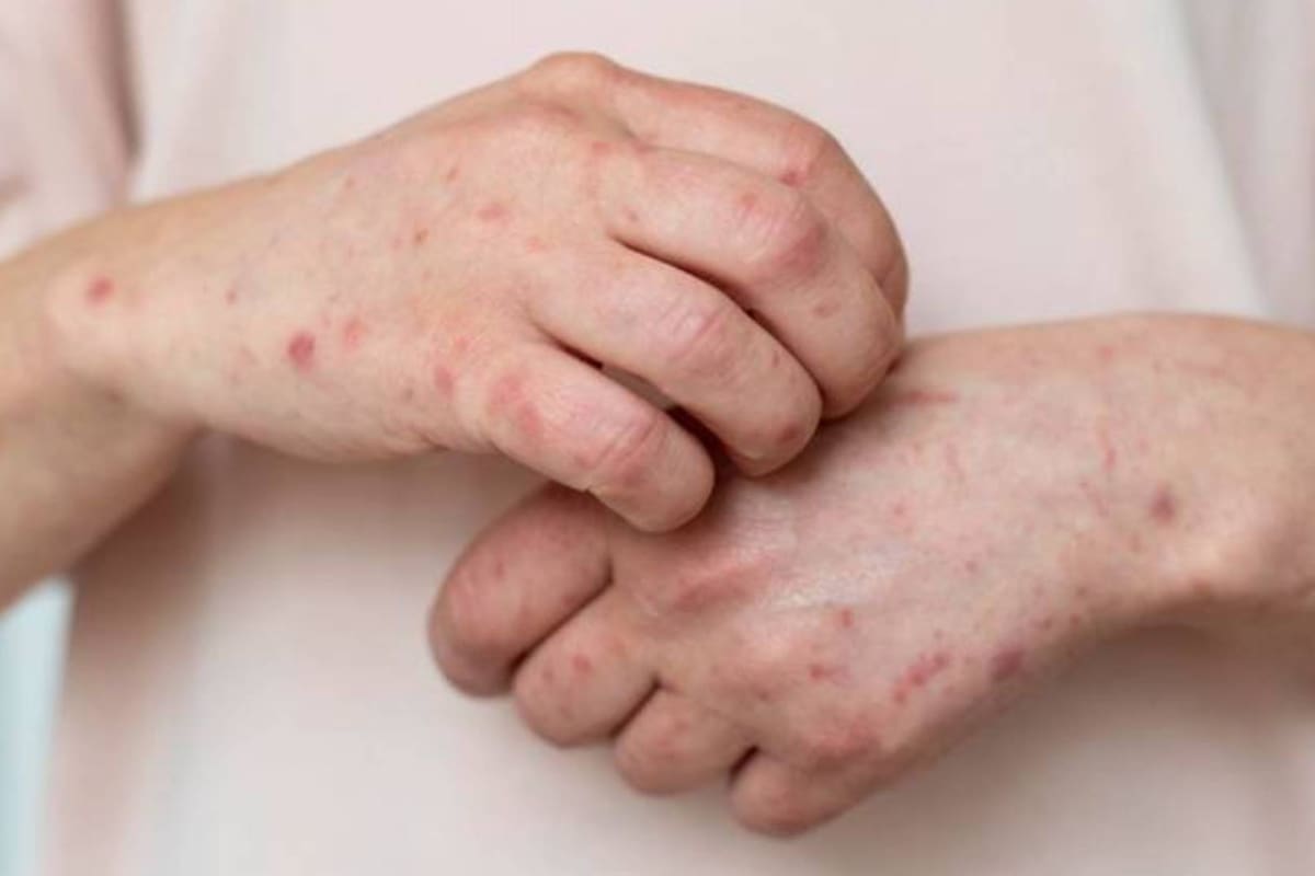 Reportan cuatro casos importados de sarampión en México durante 2024