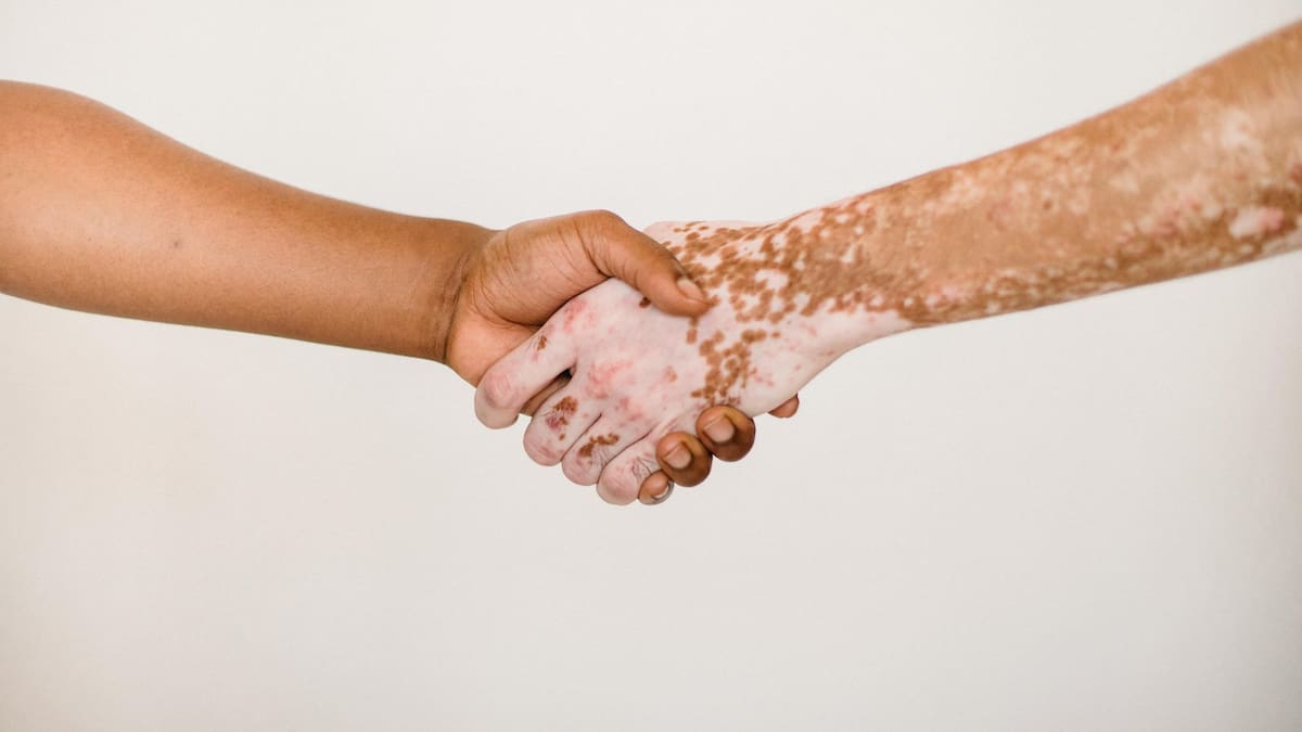El vitiligo es una enfermedad de la piel caracterizada por la pérdida de pigmento | Foto: Especial (canva)