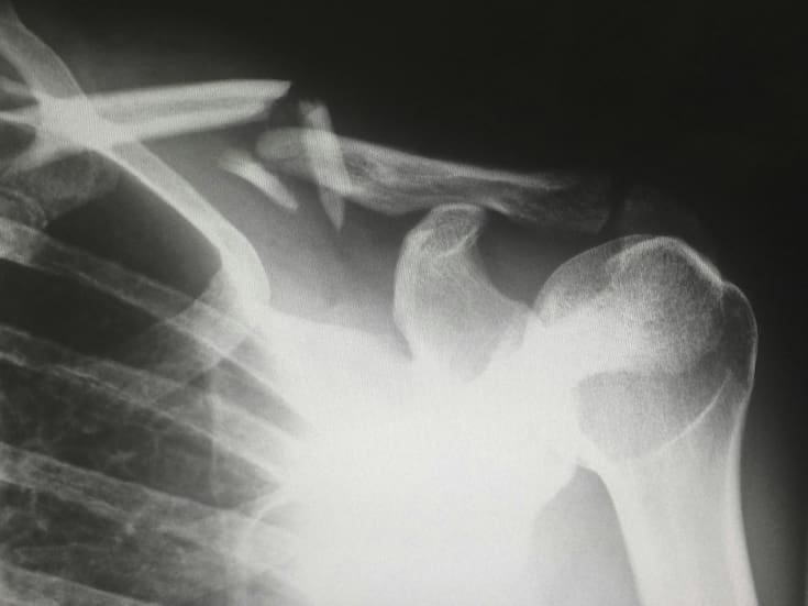 El riesgo invisible que viven millones de personas con diabetes