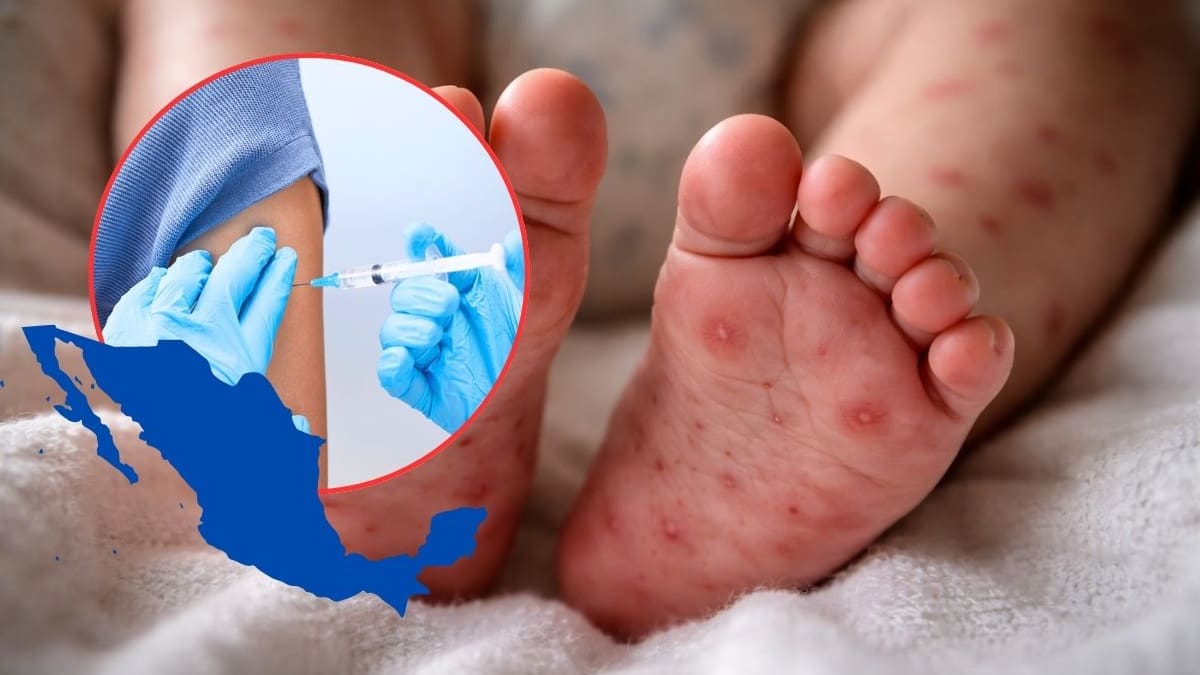 Sarampión en México aumentó más del 39% frente a todo 2025 mientras autoridades alertan por contagios en niños, muertes confirmadas y refuerzan vacunación ante riesgo de nuevos brotes