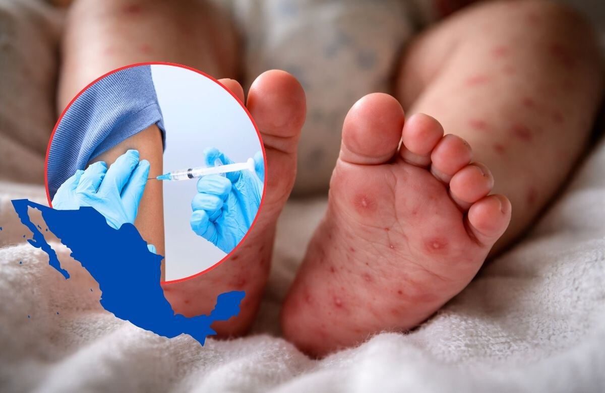 El sarampión continúa propagándose en el país, con mayor impacto en niñas y niños menores de cuatro años. FOTO: ESPECIAL