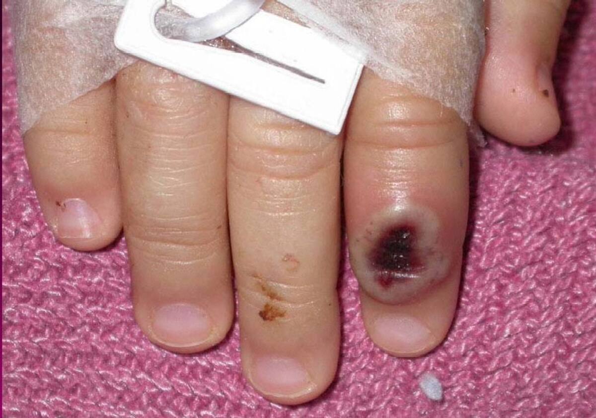 Fotografía de archivo del Centro Estadounidense de Control de las Enfermedades (CDC) en la que se aprecia el dedo de un niño infectado por la llamada ""viruela de mono"" (monkeypox). EFE/Cortesía CDC