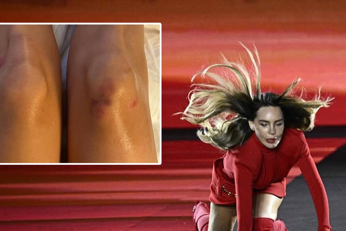 Belinda muestra heridas que sufrió tras caída en el Fashion Week de París