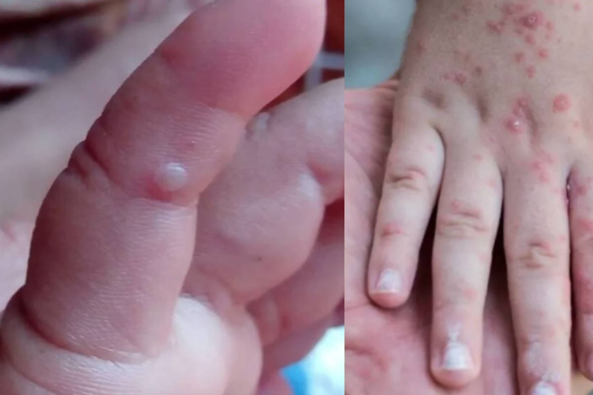 Virus Coxsackie: Infección mano, pie y boca es común en Sonora