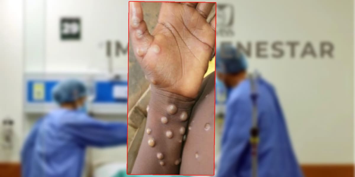 La OMS ha emitido algunas medidas en caso de diagnosticar la viruela del mono, o mpox. | Especial