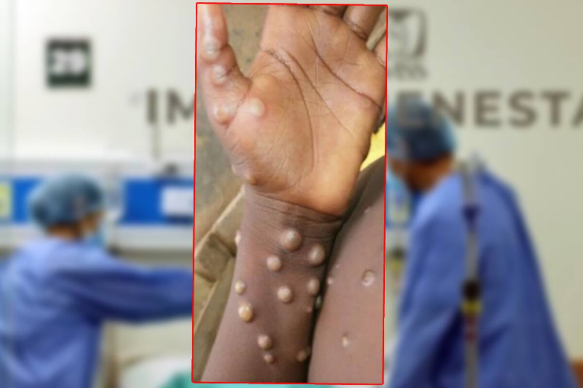 Viruela del mono: Qué hacer si te diagnostican mpox; estas son algunas recomendaciones médica