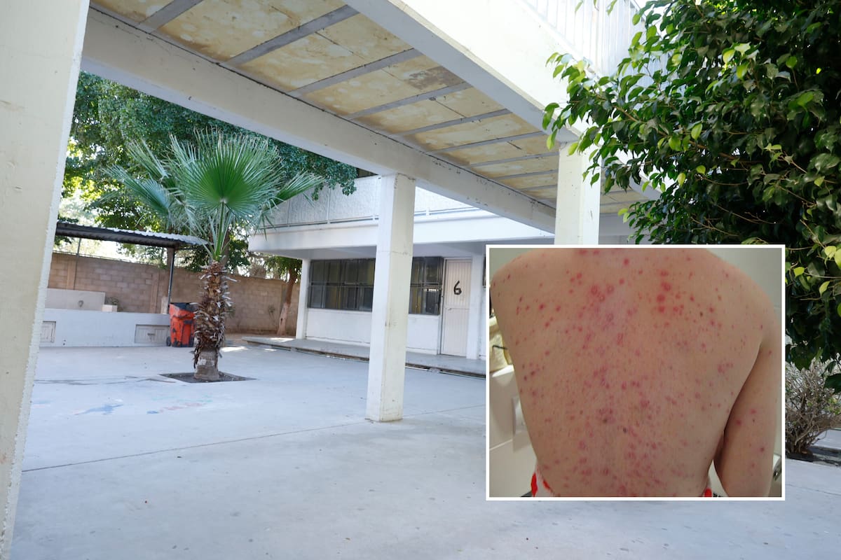Brote de varicela: ¿cuáles son sus síntomas y cuidados a tomar si se sospecha de contagio tras detectarse casos en una secundaria de Hermosillo? Esto dice Salud Sonora