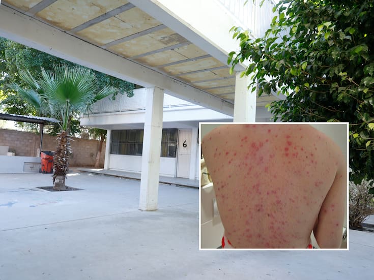 Brote de varicela: ¿cuáles son sus síntomas y cuidados a tomar si se sospecha de contagio tras detectarse casos en una secundaria de Hermosillo? Esto dice Salud Sonora