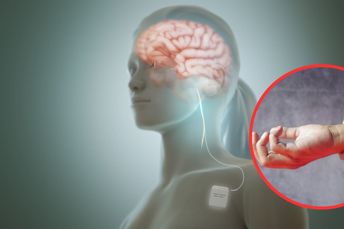 Estimulación del nervio vago: una nueva alternativa para tratar la artritis reumatoide