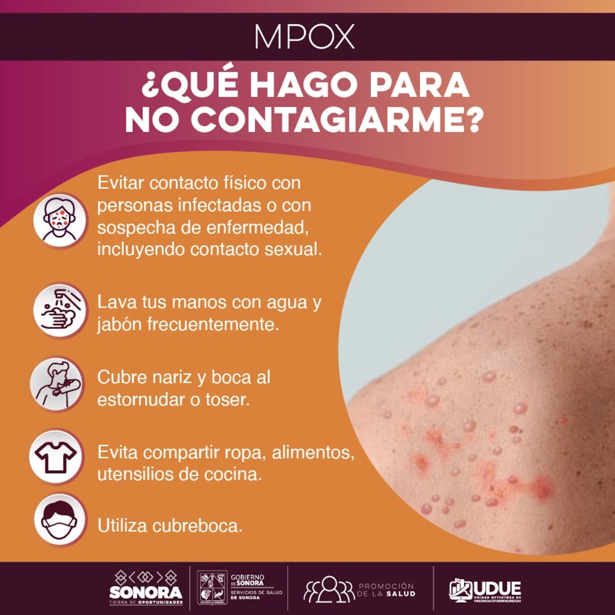 Hasta el momento y durante todo el 2024, no se han identificado ni confirmado casos de viruela del mono (MPOX) en Sonora.