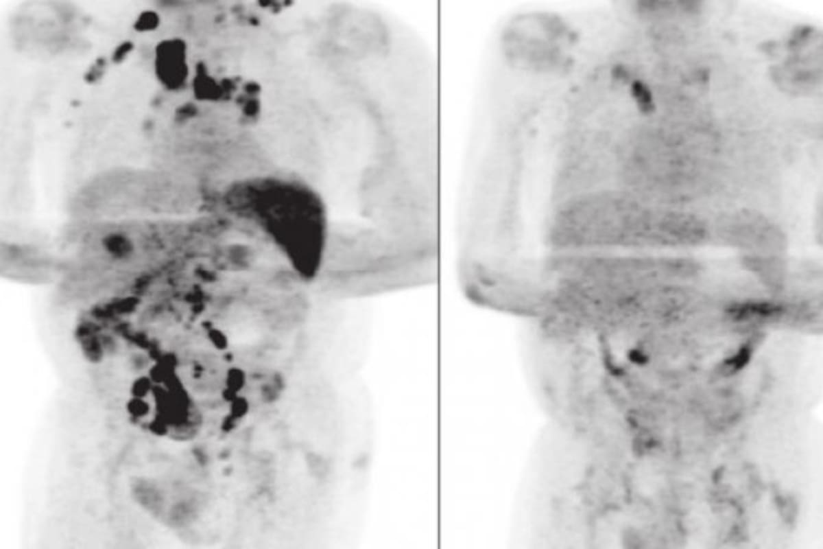 Médicos investigan caso de paciente con cáncer que se curó tras contagiarse de Covid-19