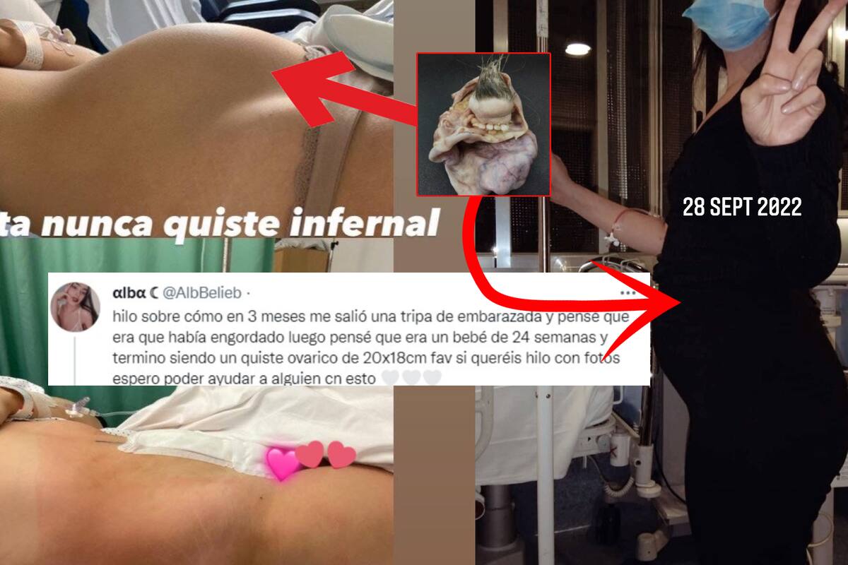 Teratoma: Le "crece pancita" a jovencita de la que le sacan "ser" con dientes y pelos