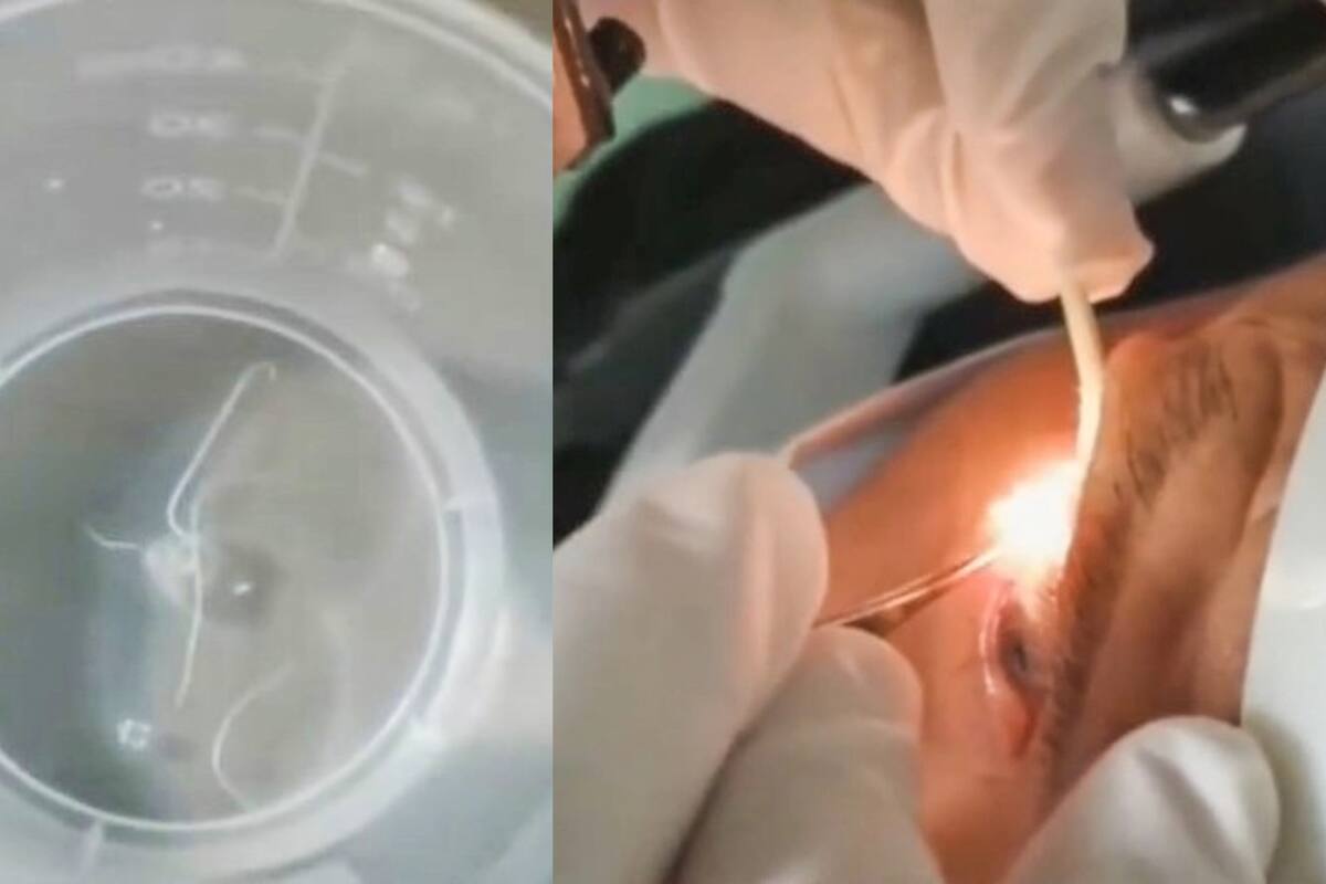 Tenía alojados más de 20 gusanos en sus ojos y lo operaron