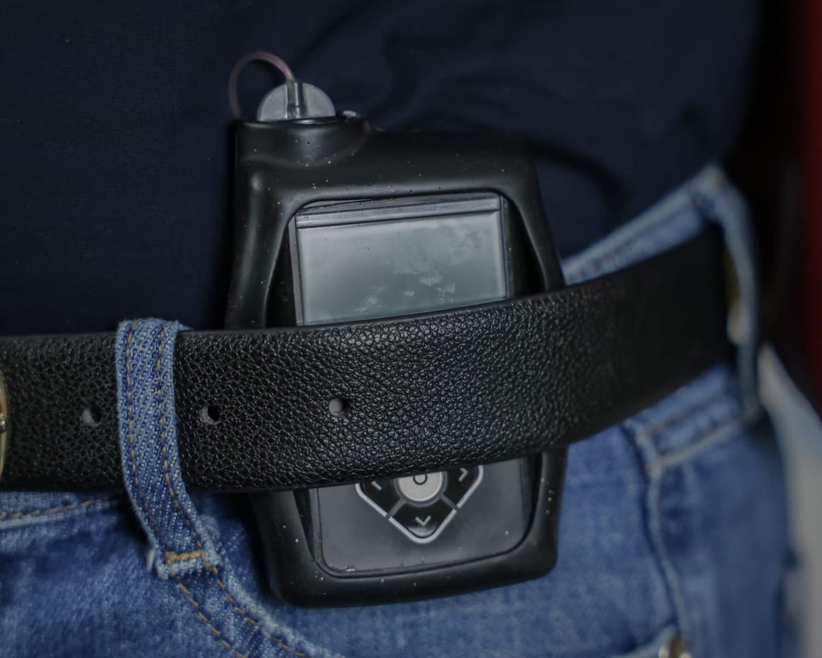 Hoy vive con una microinfusora de insulina, un dispositivo que lleva pegado al cuerpo y que le permite regular su tratamiento l Foto: Javier Gallegos