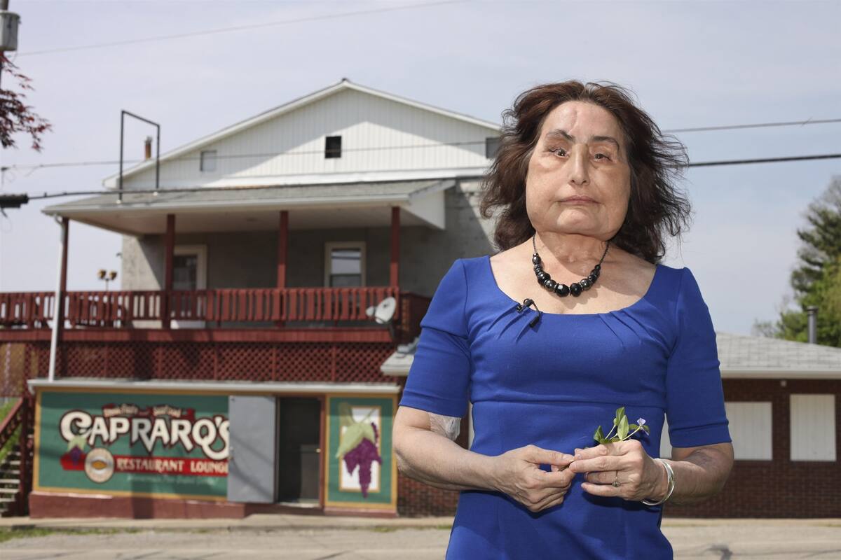 Muere a los 57 años la primera mujer que recibió trasplante facial en EU
