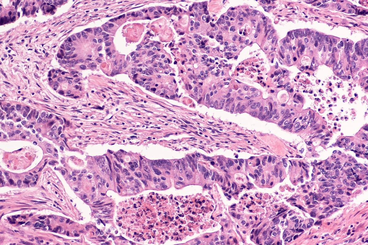 Rompe UA dogmas médicos sobre el cáncer