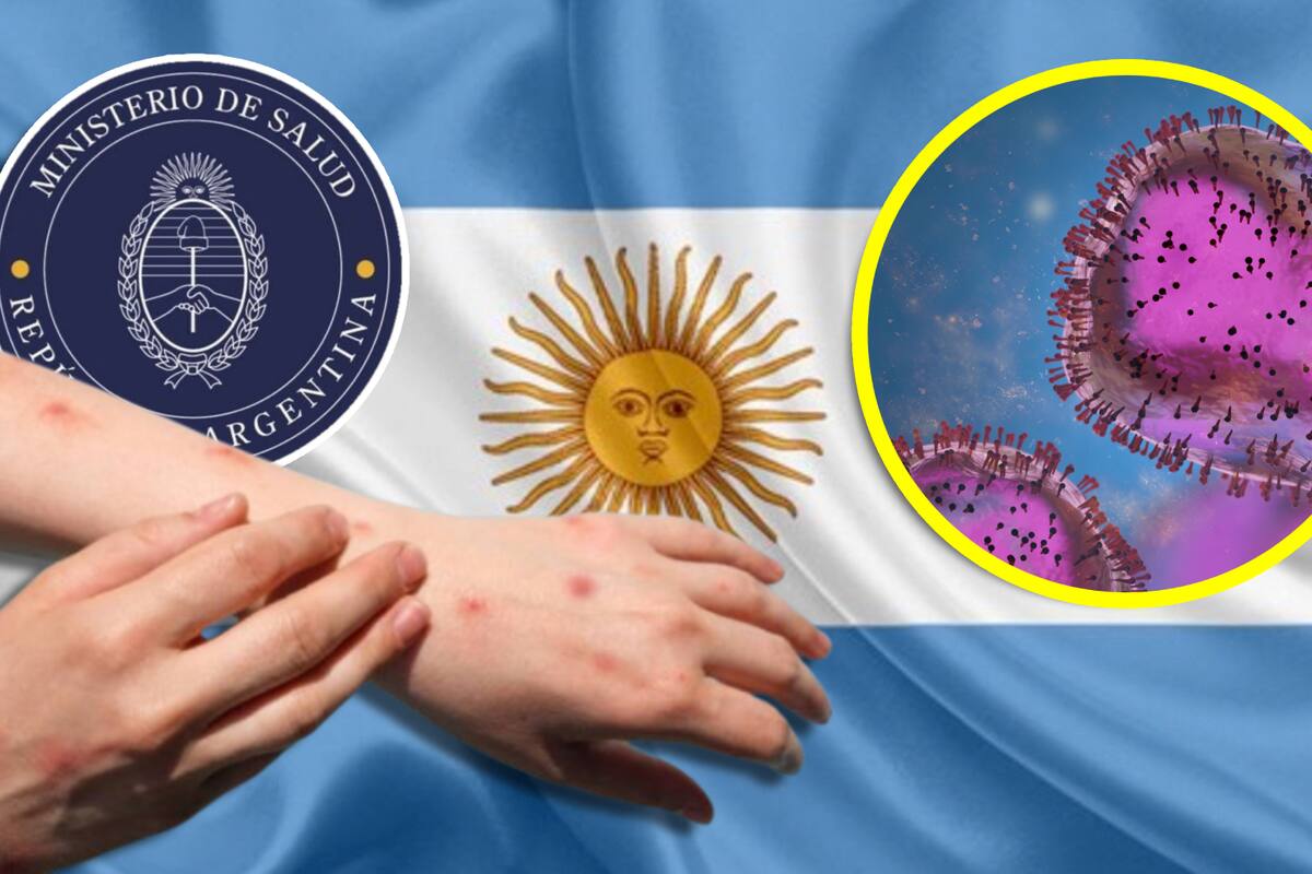 Argentina registra 78 casos de viruela símica (mpox) en 2024