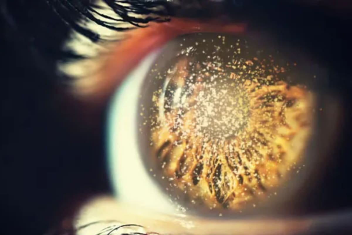 Hialosis asteroide: uno de los fenómenos oculares más fascinantes que existen