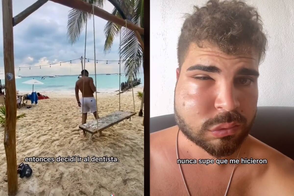 Joven español va al dentista durante sus vacaciones en México y termina con la cara deforme