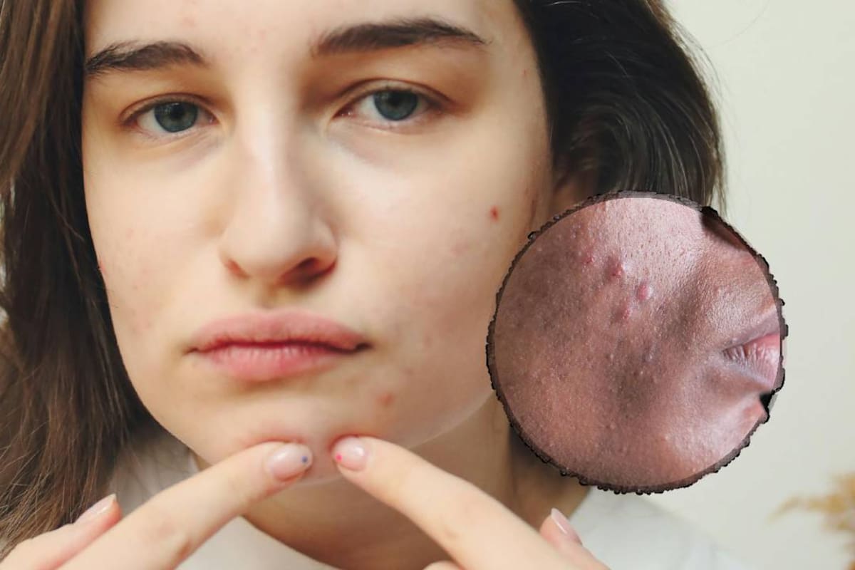 Cicatrices del acné en la cara: Esto es lo que recomienda la IA y los expertos en la piel