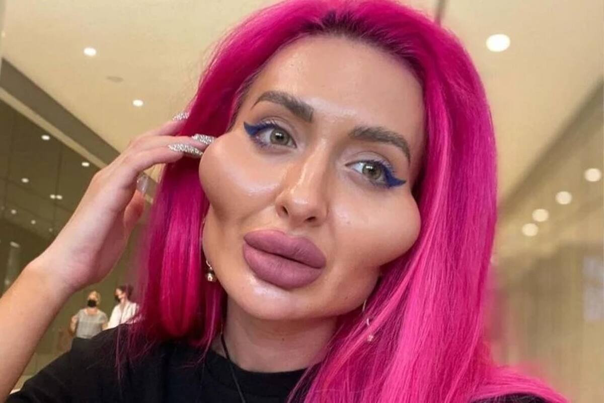 Influencer ucraniana famosa por tener “las mejillas más grandes del mundo” comparte su apariencia antes de tener rellenos