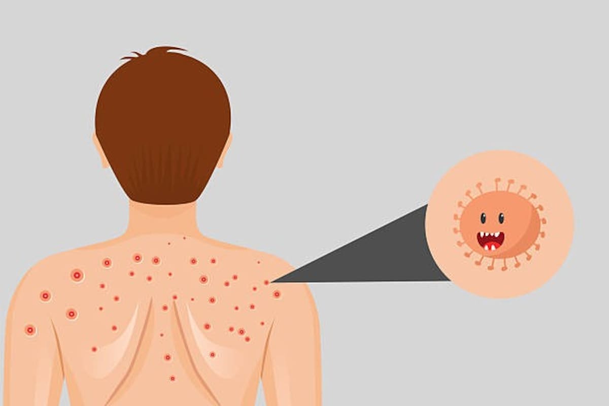 BC acumula 10 casos de sarampión en 2026