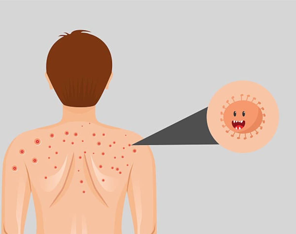 En apenas un mes, 2026 ya rebasó el promedio anual histórico, lo que pone en riesgo el estatus de eliminación si la transmisión continúa. Foto: Pixabay