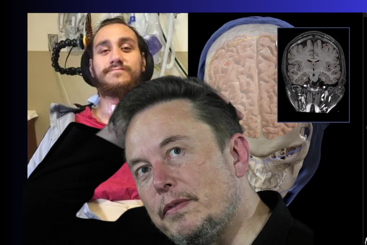 El primer chip cerebral de Neuralink transplantado en un humano se desprende del cráneo del paciente, ¿corre peligro?