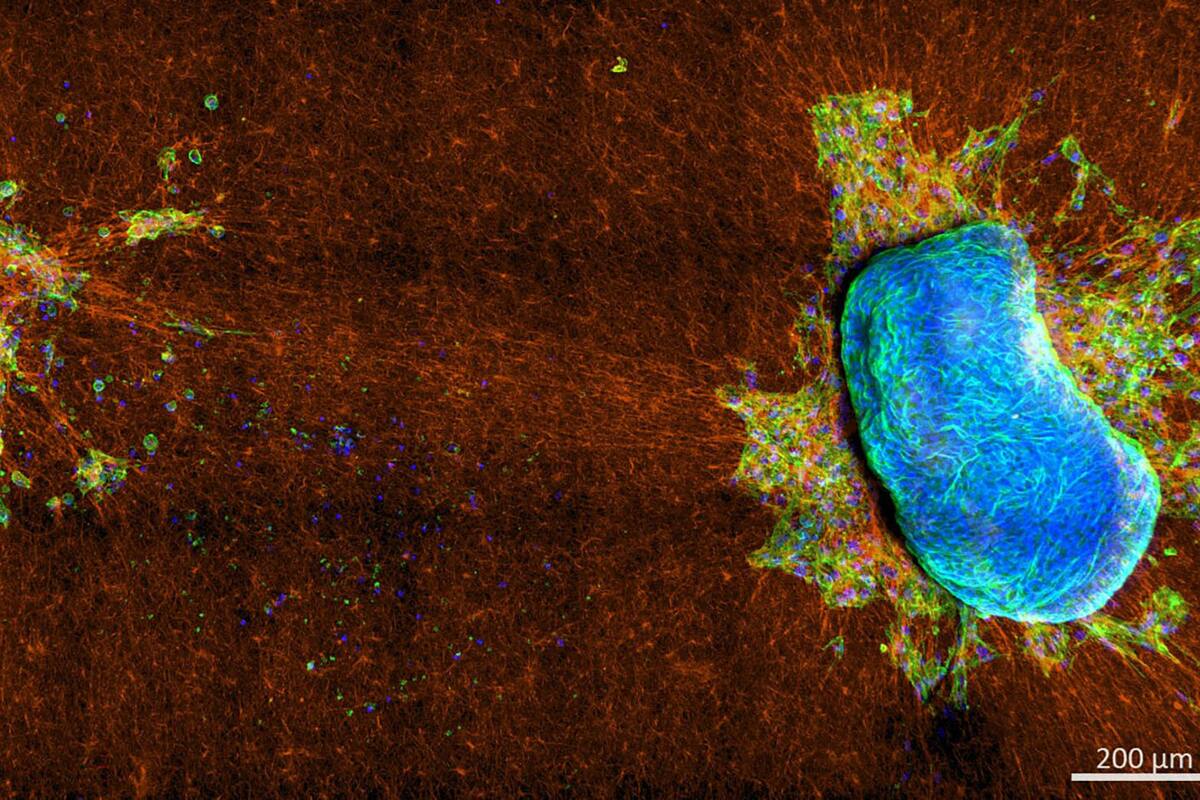 Estudio arroja información sobre la capacidad de las células cancerosas para migrar