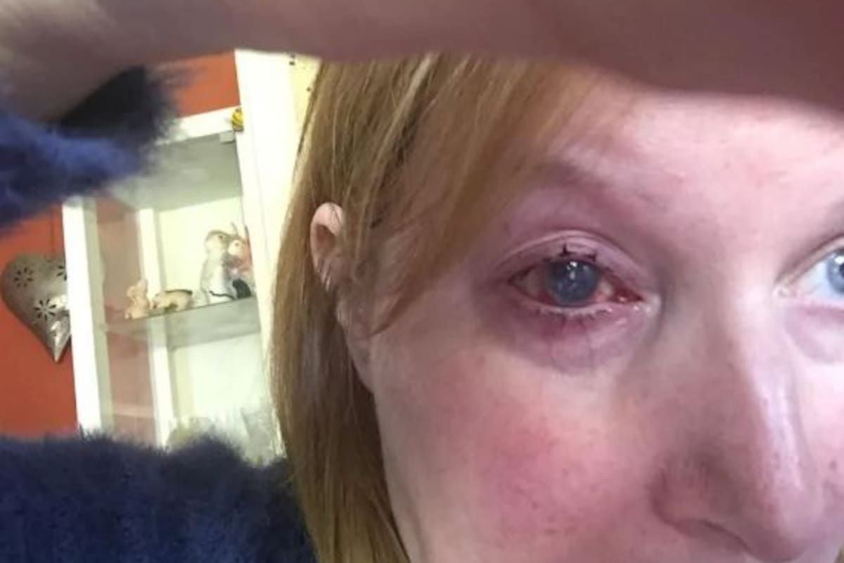 Mujer pierde ojo tras contraer infección mientras se bañaba
