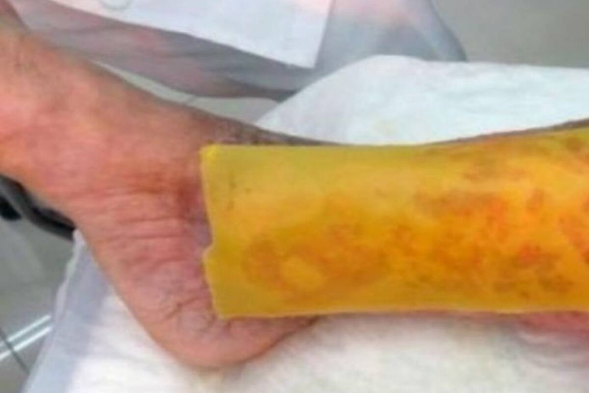 El parche de miel que evita amputaciones en pacientes con diabetes