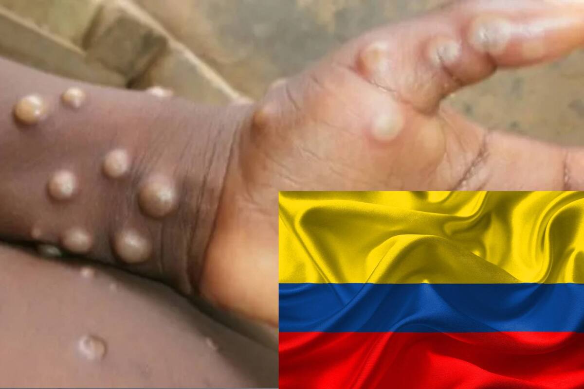 Se confirman los primeros tres casos de viruela del mono en Colombia
